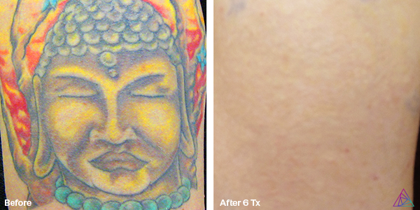 Before and after tattoo removal